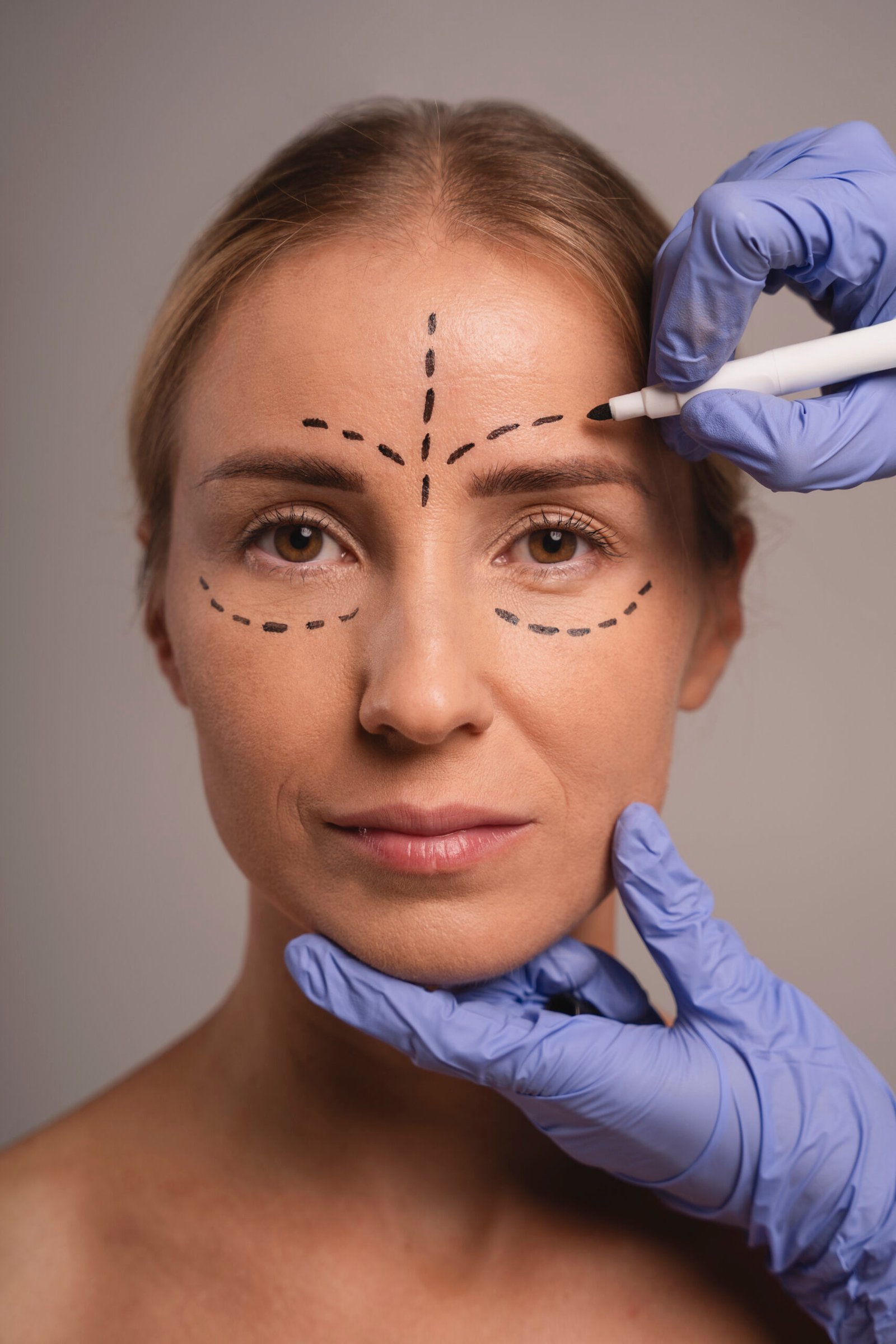 Blefaroplastia 